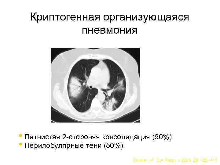 Криптогенная организующаяся пневмония • Пятнистая 2 -стороняя консолидация (90%) • Перилобулярные тени (50%) Cordier