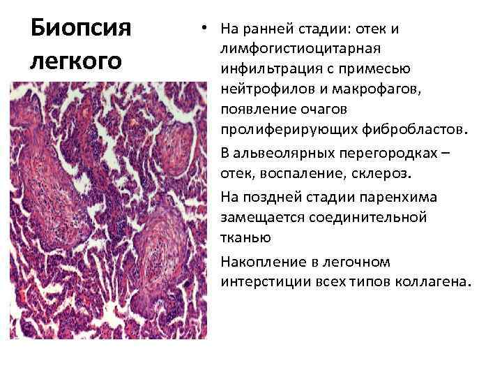 Биопсия легкого • На ранней стадии: отек и лимфогистиоцитарная инфильтрация с примесью нейтрофилов и