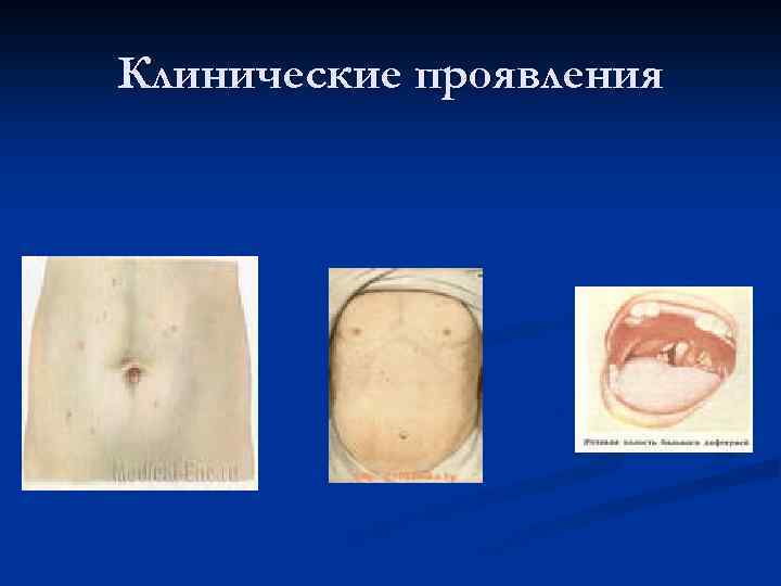 Клинические проявления 