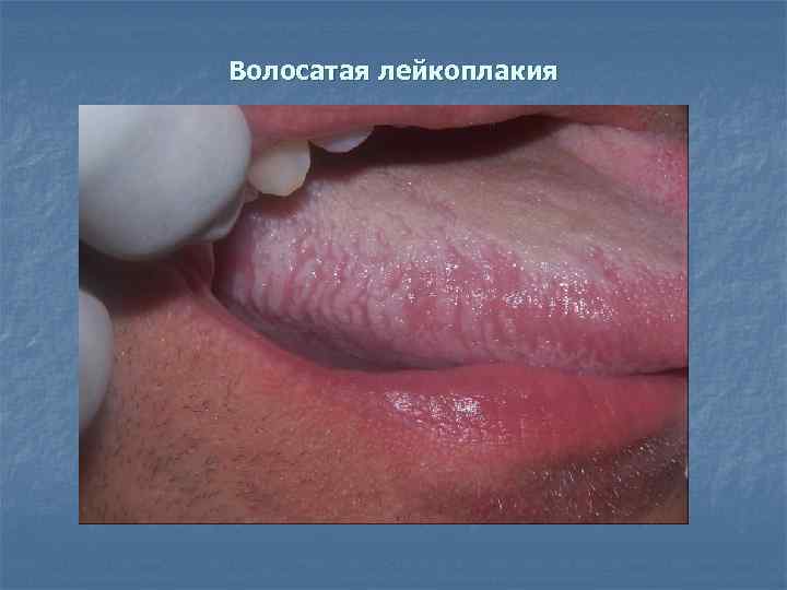 Волосатая лейкоплакия 
