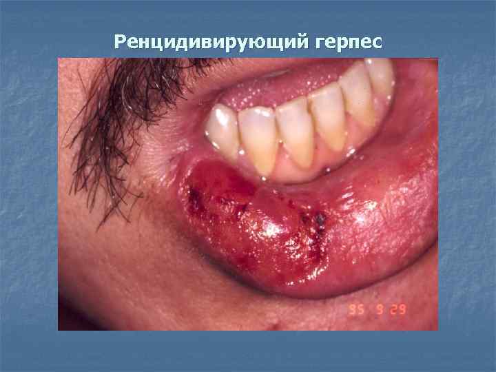 Ренцидивирующий герпес 