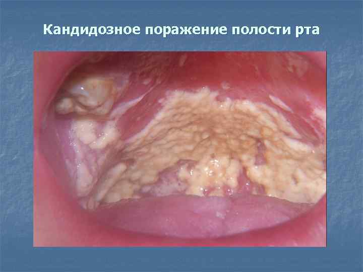 Кандидозное поражение полости рта 