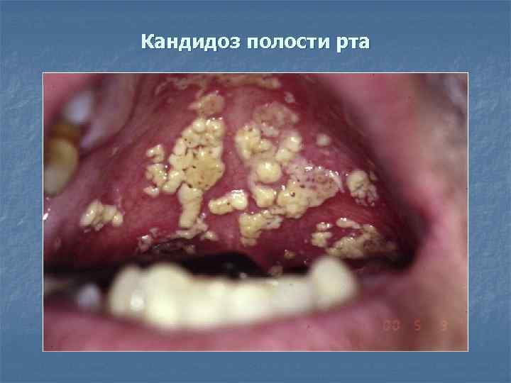 Кандидоз полости рта 