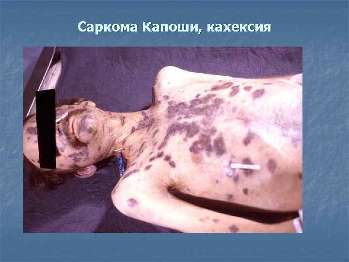 Саркома Капоши, кахексия 