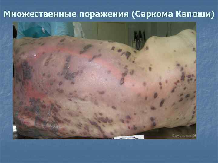 Множественные поражения (Саркома Капоши) 