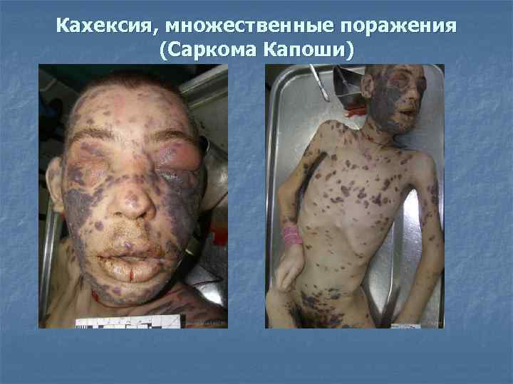 Кахексия, множественные поражения (Саркома Капоши) 