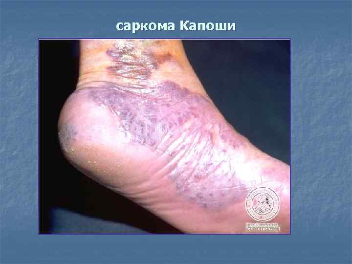 саркома Капоши 