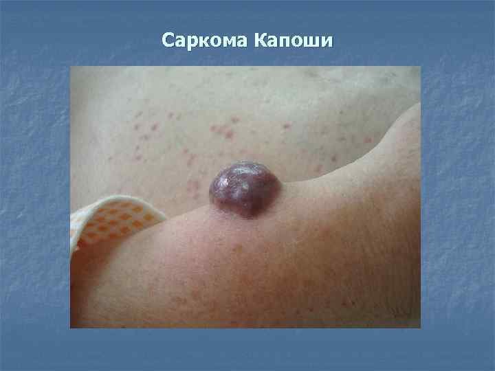 Саркома Капоши 