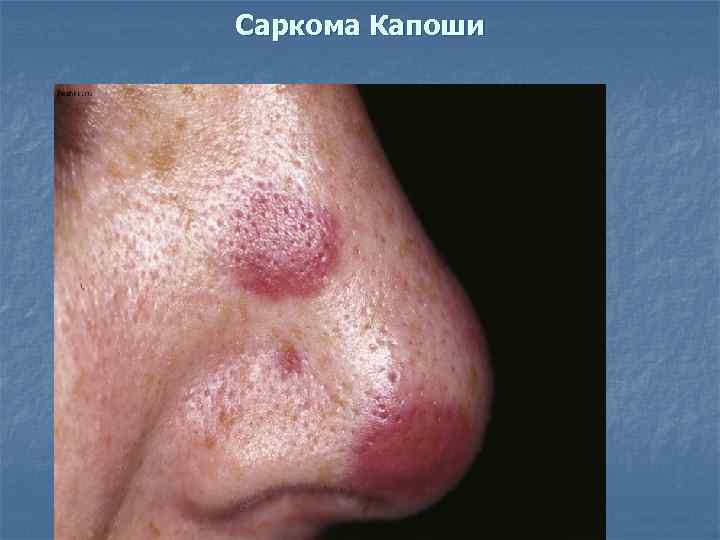 Саркома Капоши 