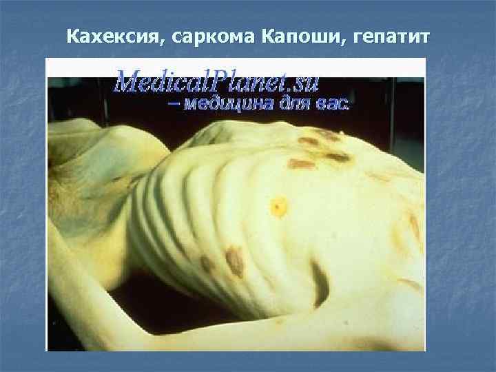 Кахексия, саркома Капоши, гепатит 