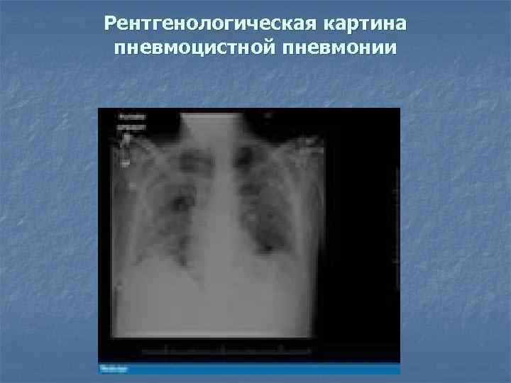 Рентгенологическая картина пневмоцистной пневмонии 