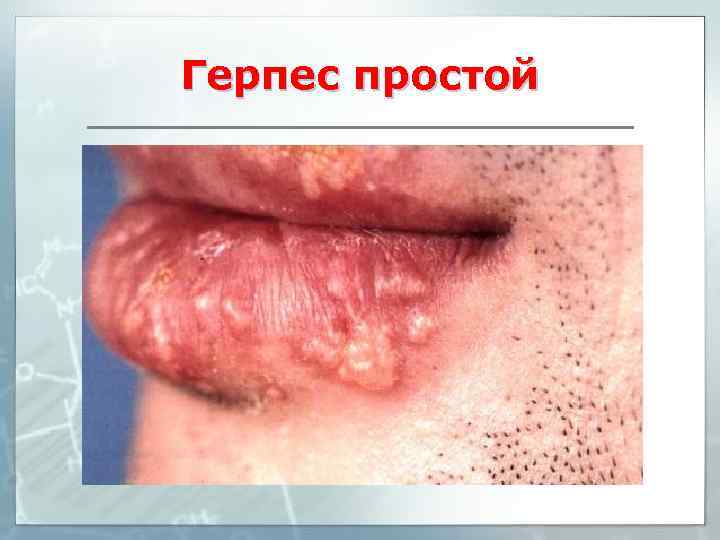 Герпес простой 