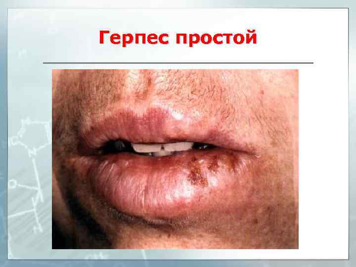 Герпес простой 
