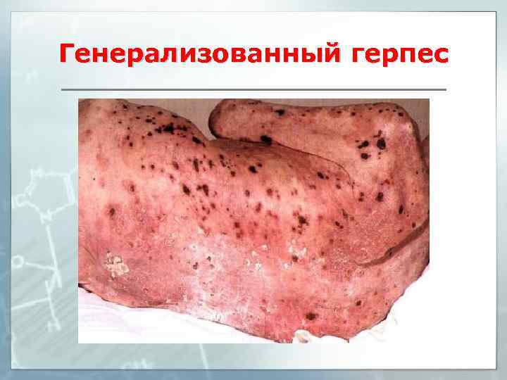 Генерализованный герпес 