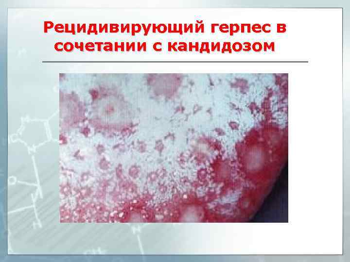 Рецидивирующий герпес в сочетании с кандидозом 