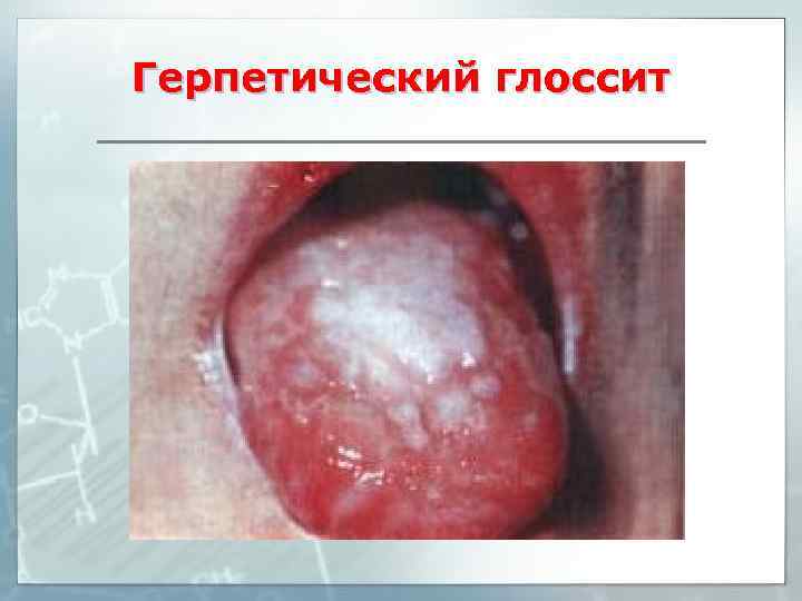 Герпетический глоссит 