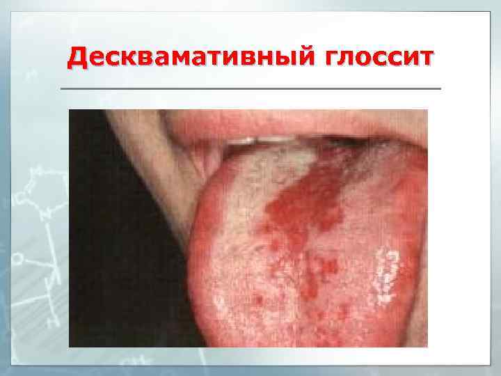 Десквамативный глоссит 