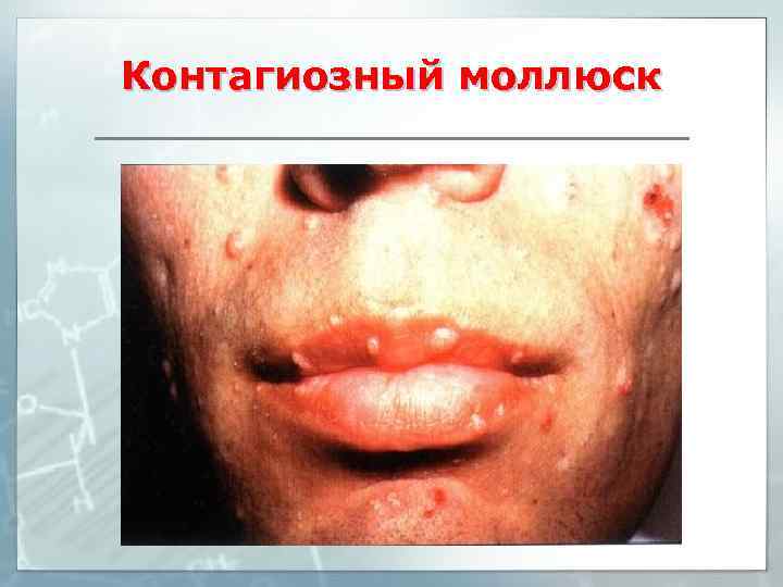 Контагиозный моллюск 