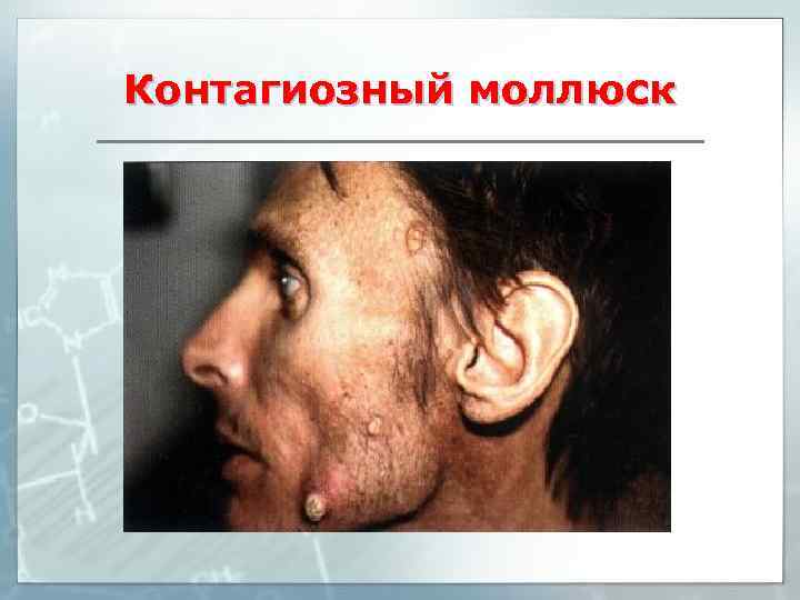 Контагиозный моллюск 