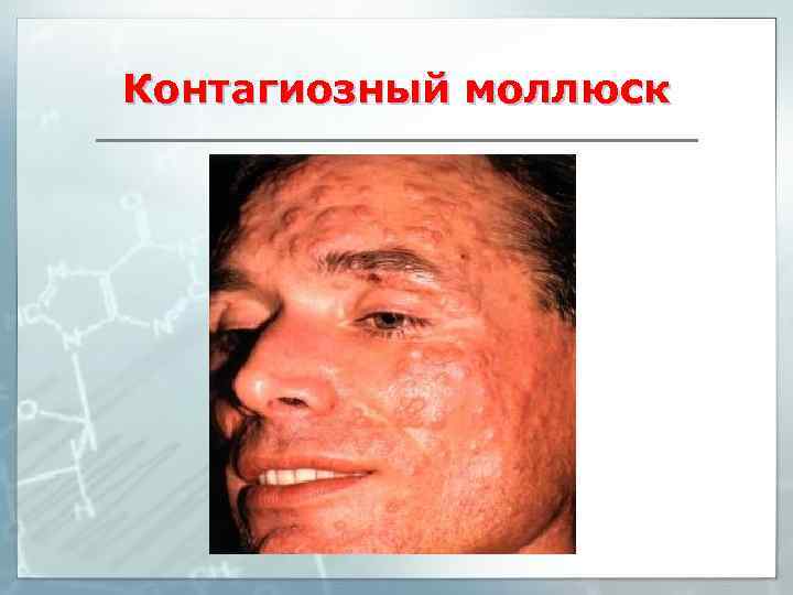 Контагиозный моллюск 