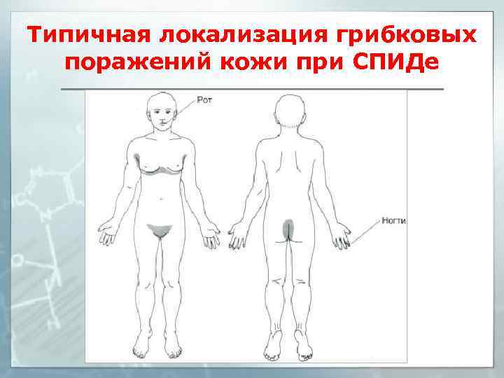Типичная локализация грибковых поражений кожи при СПИДе 