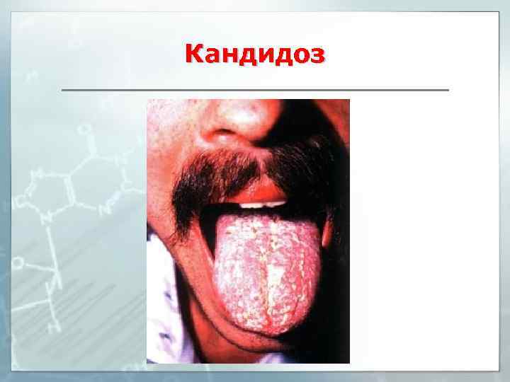 Кандидоз 