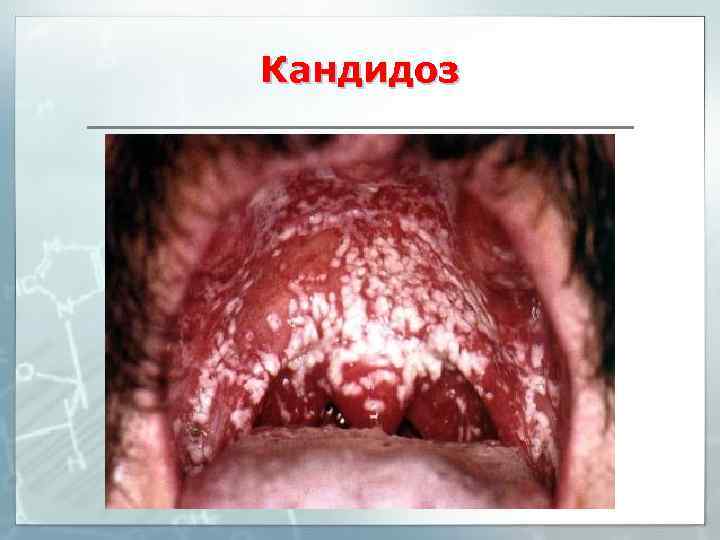 Кандидоз 