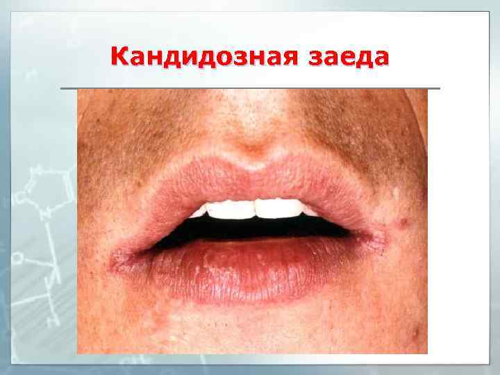 Кандидозная заеда 