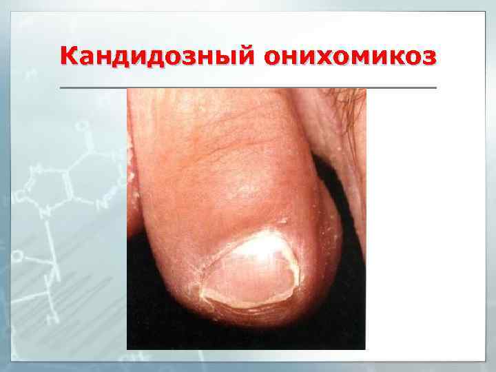 Кандидозный онихомикоз 