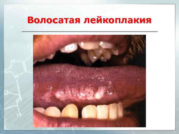 Волосатая лейкоплакия 