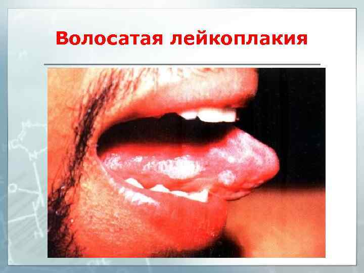 Волосатая лейкоплакия 