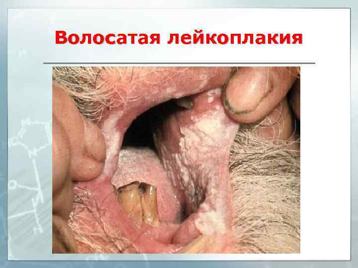 Волосатая лейкоплакия 