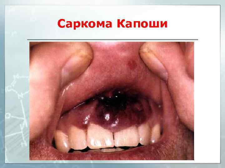 Саркома Капоши 