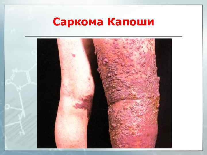 Саркома Капоши 