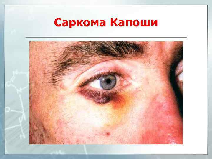 Саркома Капоши 