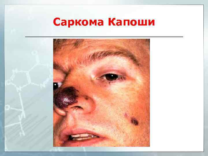 Саркома Капоши 