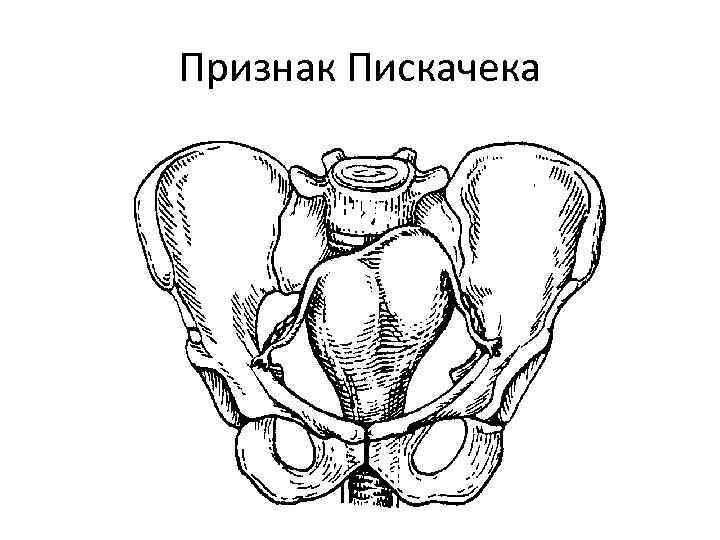 Признак Пискачека 