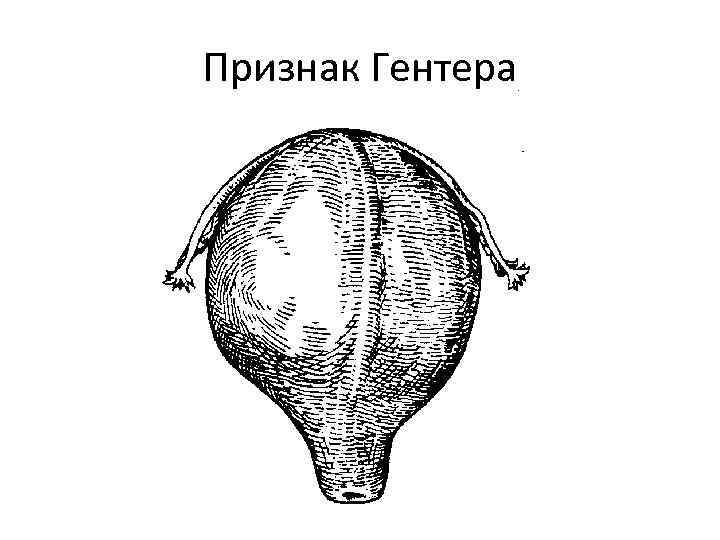 Признак Гентера 