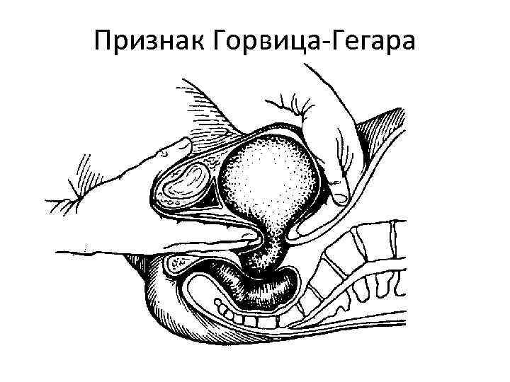 Признак Горвица-Гегара 