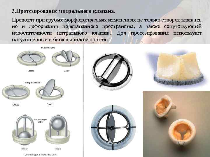 Осложнения недостаточности митрального клапана