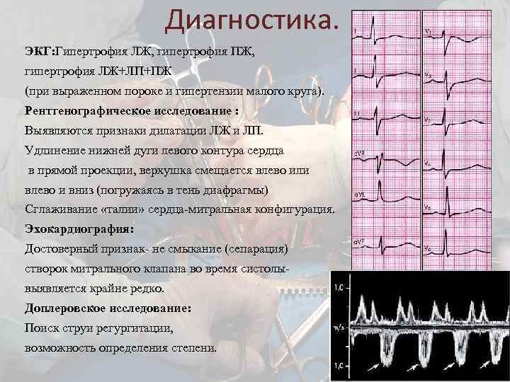 Диагностика. ЭКГ: Гипертрофия ЛЖ, гипертрофия ПЖ, гипертрофия ЛЖ+ЛП+ПЖ (при выраженном пороке и гипертензии малого