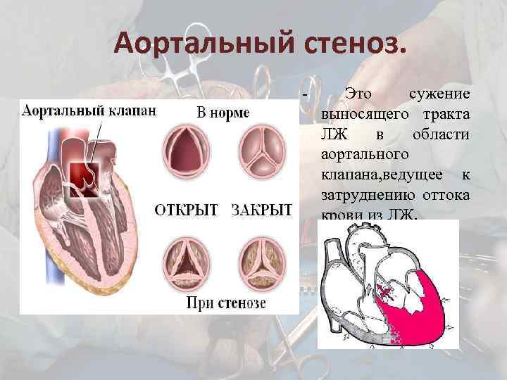 Аортальный стеноз. - Это сужение выносящего тракта ЛЖ в области аортального клапана, ведущее к