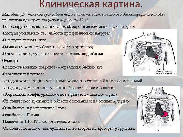 Клиническая картина. Жалобы: Длительное время больной не испытывает заметного дискомфорта. Жалобы возникают при сужении