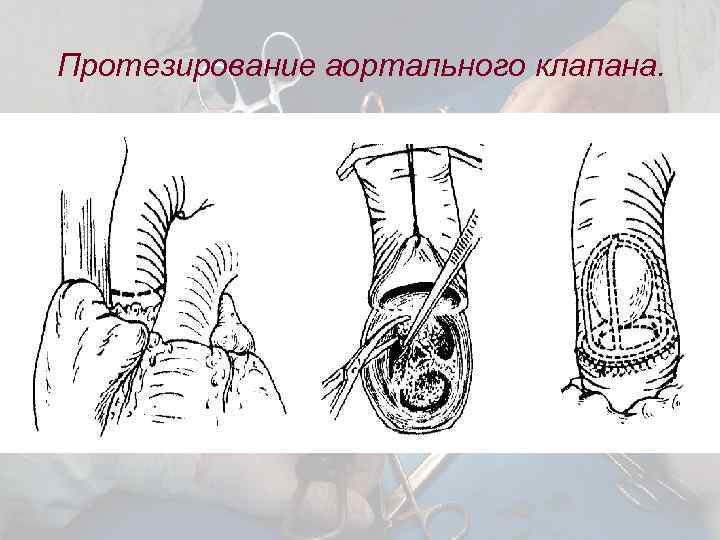 Операция клапана. Тави операция на аортальном клапане. Транскатетерное протезирование аортального клапана. Протез аортального клапана. Протезирование аортального клапана схема.