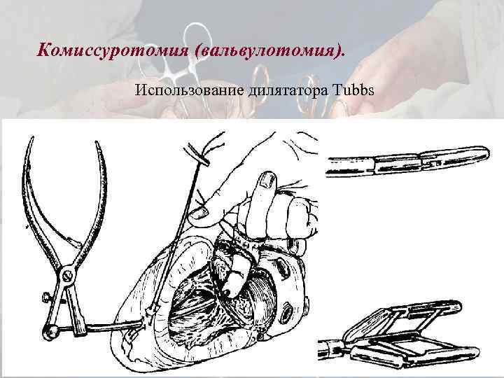 Комиссуротомия (вальвулотомия). Использование дилятатора Tubbs 