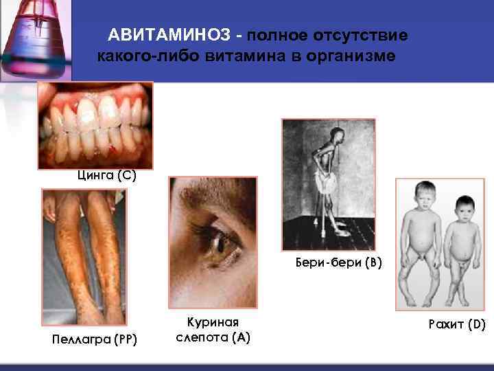 АВИТАМИНОЗ - полное отсутствие какого-либо витамина в организме Цинга (С) Бери-бери (В) Пеллагра (РР)