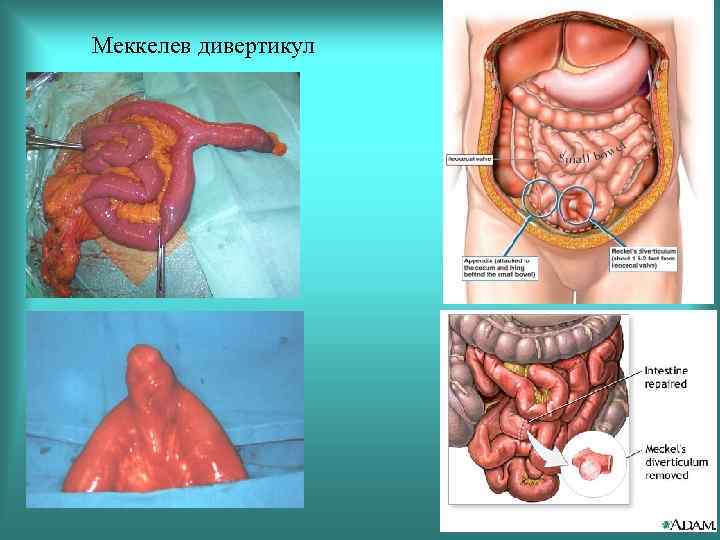 Меккелев дивертикул 