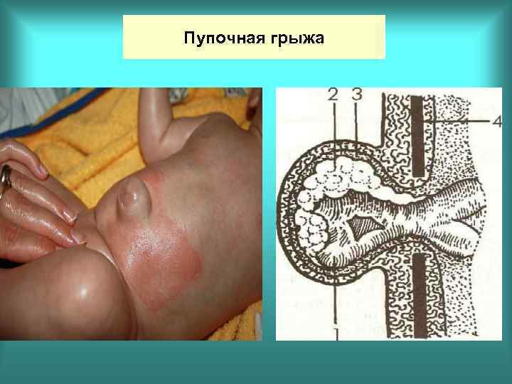 Пупочная грыжа 