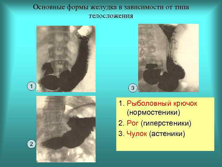 Формы желудка. Формы желудка в зависимости от телосложения. Форма желудка в зависимости от типа телосложения. Формы желудка на рентгенограмме. Формы желудка у людей различных типов.