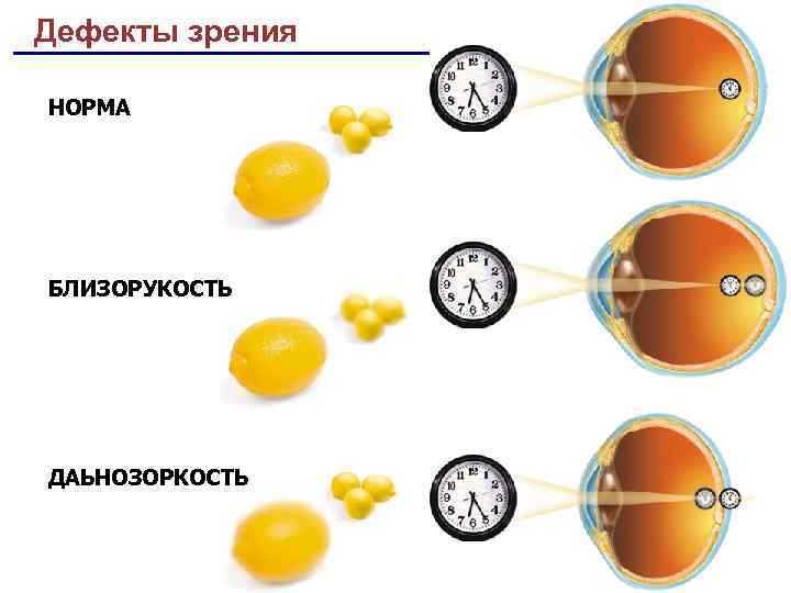 Какое нормальное зрение. Дефекты зрения. Дефекты зрения близорукость. Причины дефектов зрения. Норма и близорукость.